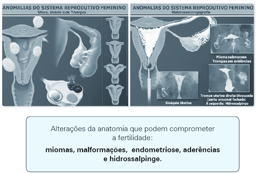 Anomalias do Sistema Reprodutivo Feminino